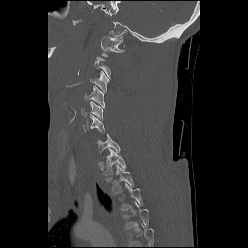 Bilateral perched facets with cord injury (Radiopaedia 45587-49713 Sagittal bone window 37).jpg