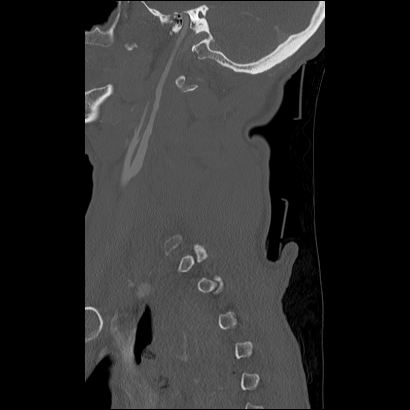 Bilateral perched facets with cord injury (Radiopaedia 45587-49713 Sagittal bone window 8).jpg