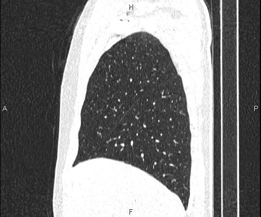 File:Bilateral pulmonary AVM (Radiopaedia 83134-97505 Sagittal lung window 31).jpg