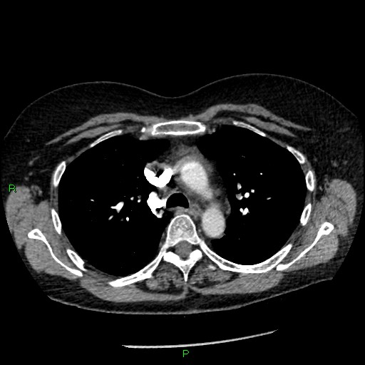 Bilateral pulmonary emboli (Radiopaedia 32700-33669 Axial C+ CTPA 37).jpg