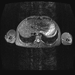 File:Bilateral spinoglenoid notch ganglion cysts (Radiopaedia 29577-30082 E 30).jpg