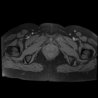 Bilateral tubo-ovarian abscesses (Radiopaedia 58635-65829 Axial T1 fat sat 43).jpg