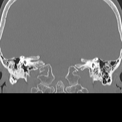 File:Bilateral tympanoplasty (Radiopaedia 16947-16664 Coronal bone window 16).jpg