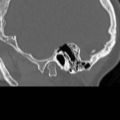 File:Bilateral tympanoplasty (Radiopaedia 16947-16664 Sagittal bone window 9).jpg