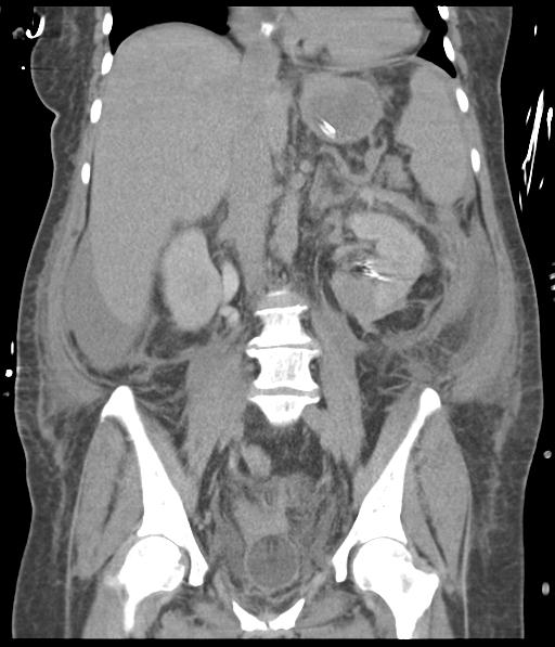 File:Bladder rupture post renal biopsy (Radiopaedia 30863-31572 Coronal non-contrast 34).jpg
