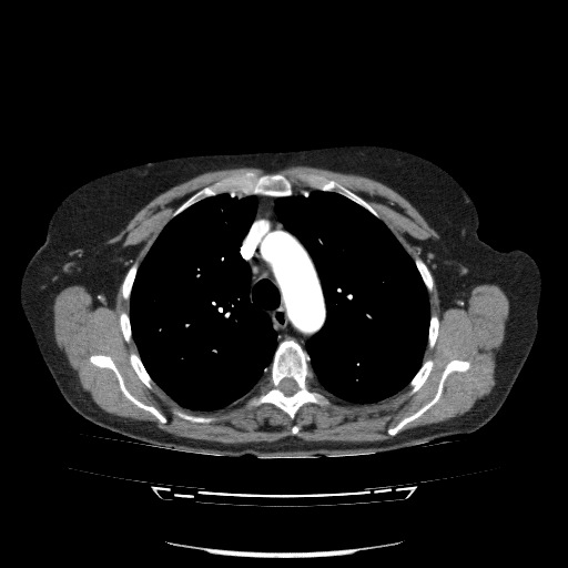 File:Bladder tumor detected on trauma CT (Radiopaedia 51809-57609 A 33).jpg