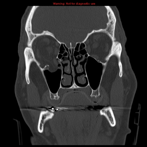 File:Blowout fracture with inferior rectus entrapment (Radiopaedia 12418-12673 Coronal bone window 9).jpg