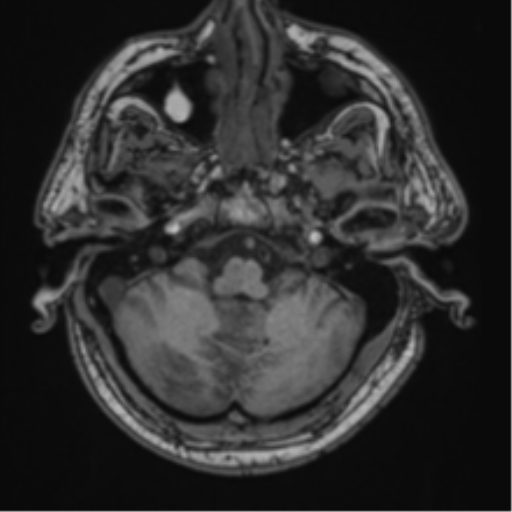 File:Blunt cerebrovascular injury (Radiopaedia 53682-59745 Axial T1 7).png