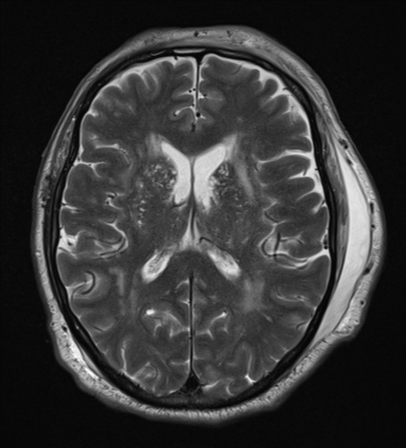 File:Blunt cerebrovascular injury (Radiopaedia 53682-59745 Axial T2 18).png