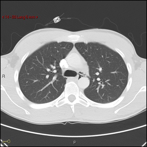 Blunt chest trauma - pulmonary interstitial emphysema and pneumomediastinum (Radiopaedia 20666-20552 Axial lung window 20).jpg