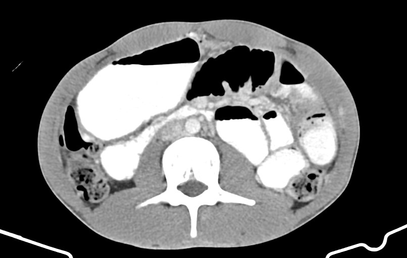 Blunt injury to the small bowel (Radiopaedia 74953-85987 A 82).jpg