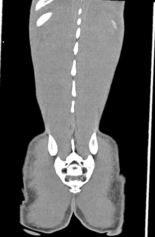 Blunt injury to the small bowel (Radiopaedia 74953-85987 B 88).jpg