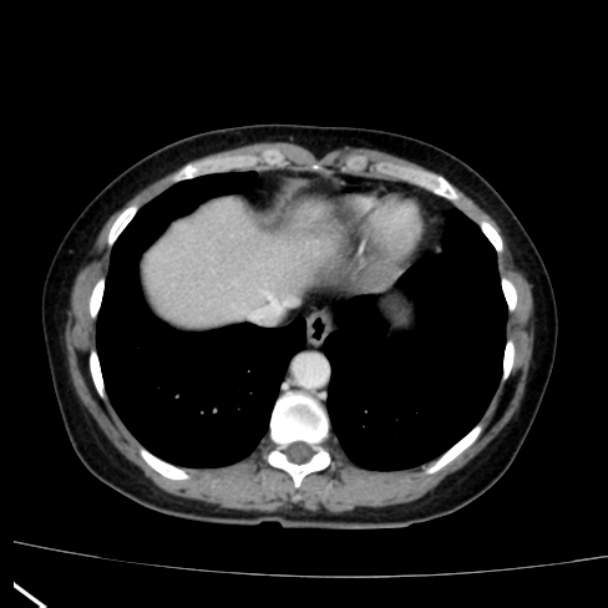 Bosniak renal cyst - type I (Radiopaedia 27479-27675 C 6).jpg