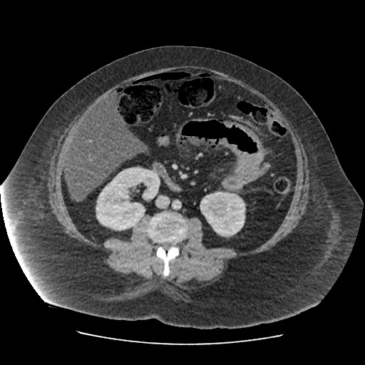 File:Bowel and splenic infarcts in acute lymphocytic leukemia (Radiopaedia 61055-68915 A 71).jpg