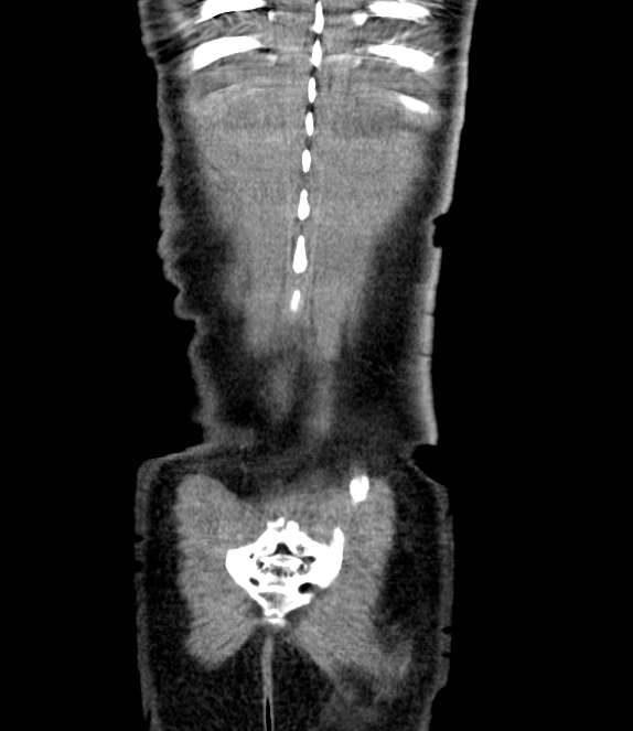 Bowel obstruction from colon carcinoma (Radiopaedia 22995-23028 C 71).jpg