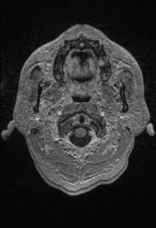 Brain abscess with ventriculitis (Radiopaedia 85703-101495 Axial T1 C+ 11).jpg