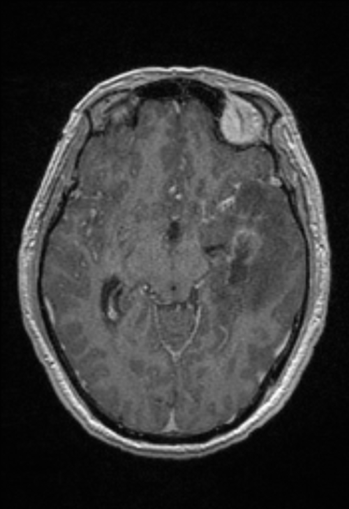 Brain abscess with ventriculitis (Radiopaedia 85703-101495 Axial T1 C+ 80).jpg