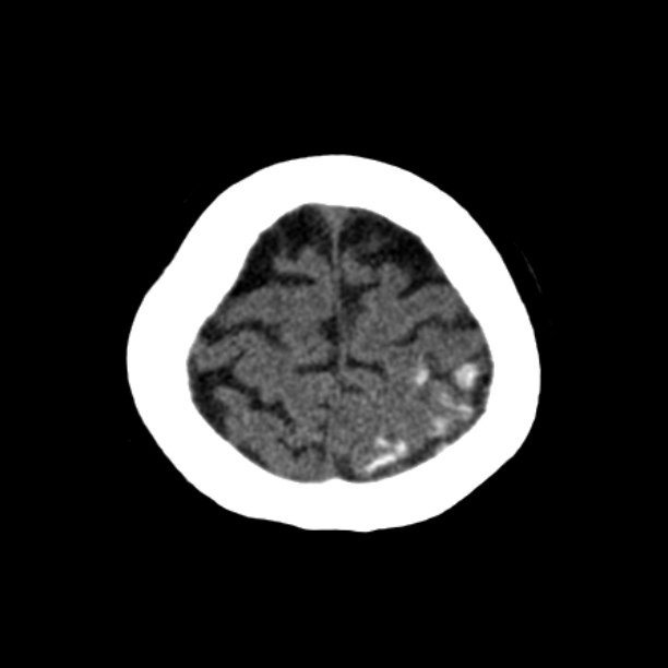 Brain cortical laminar necrosis (Radiopaedia 25822-25971 Axial non-contrast 42).jpg