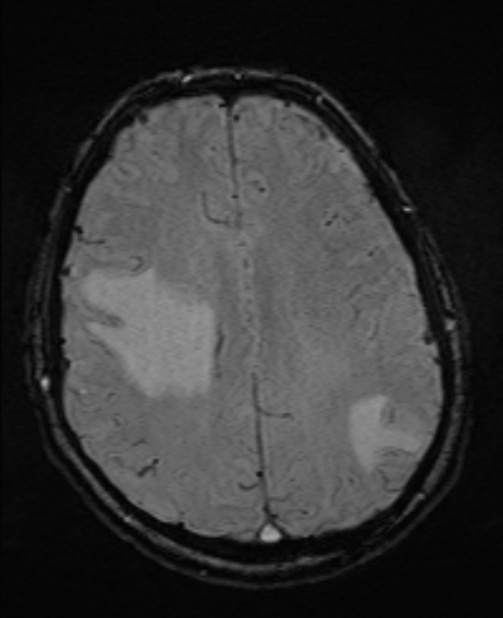 Brain metastases - lung cancer primary (Radiopaedia 75060-86115 Axial SWI 41).jpg