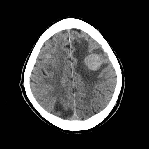 File:Brain metastases from lung cancer (Radiopaedia 83839-99027 Axial non-contrast 27).jpg