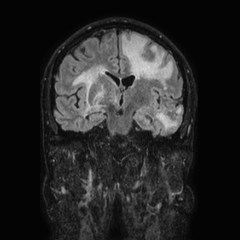 Brain metastases from lung cancer (Radiopaedia 83839-99028 Coronal FLAIR 38).jpg