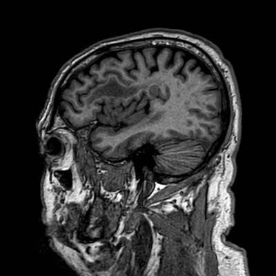 Brain metastases from lung cancer (Radiopaedia 83839-99028 Sagittal T1 27).jpg