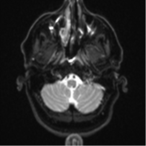 Brain metastasis (large cystic mass) (Radiopaedia 47497-52107 Axial DWI 3).png
