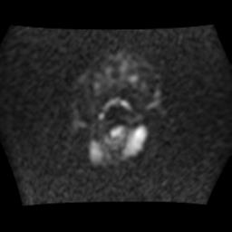 File:Brainstem glioma (Radiopaedia 30923-31624 Axial DWI 2).jpg