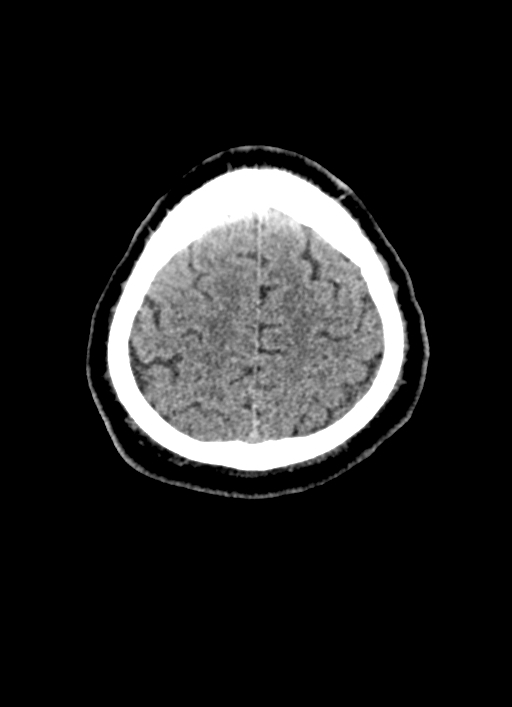 Brainstem hemorrhage (Radiopaedia 81294-94976 Axial non-contrast 13).jpg