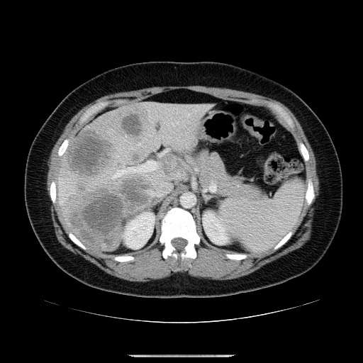 File:Breast cancer pseudocirrhosis after chemotherapy (Radiopaedia 65407-74456 Axial 7).jpg