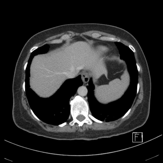 Breast metastases from renal cell cancer (Radiopaedia 79220-92225 C 9).jpg