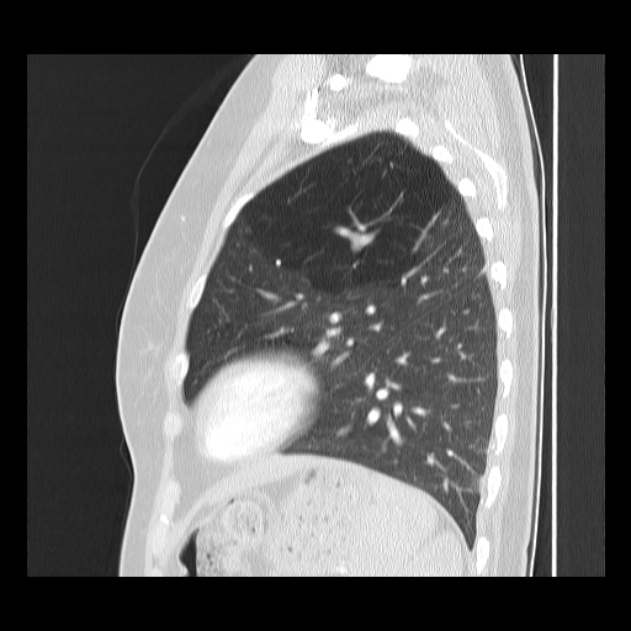 Bronchial atresia (Radiopaedia 22965-22992 Sagittal lung window 15).jpg