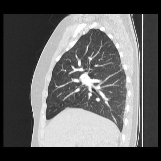 Bronchial atresia (Radiopaedia 22965-22992 Sagittal lung window 37).jpg