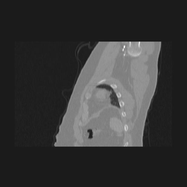 Bronchial atresia (Radiopaedia 60685-68439 Sagittal lung window 91).jpg