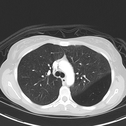 Bronchial atresia (Radiopaedia 73677-84470 Axial lung window 23).jpg