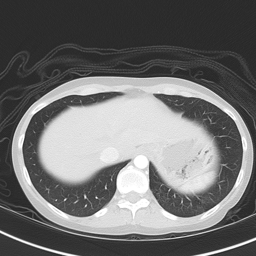 File:Bronchial atresia (Radiopaedia 73677-84470 Axial lung window 50).jpg