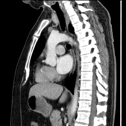 File:Bronchial carcinoid tumor (Radiopaedia 67377-76764 E 36).jpg