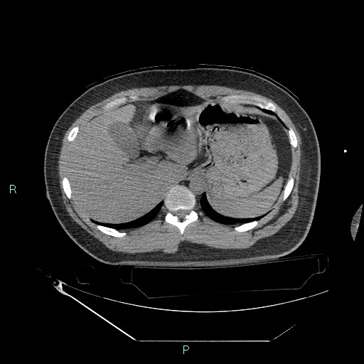 Bronchial carcinoid tumor (Radiopaedia 78272-90870 Axial non-contrast 101).jpg