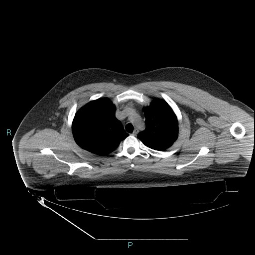 Bronchial carcinoid tumor (Radiopaedia 78272-90870 Axial non-contrast 24).jpg