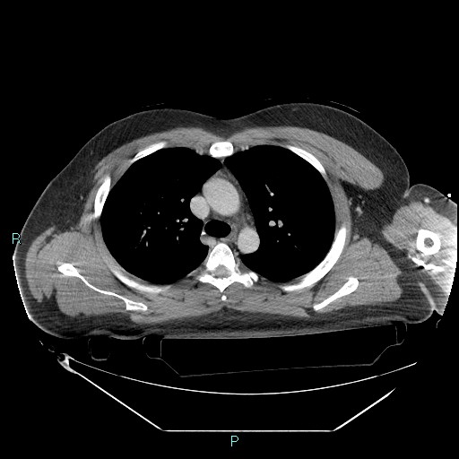 Bronchial carcinoid tumor (Radiopaedia 78272-90870 C 44).jpg