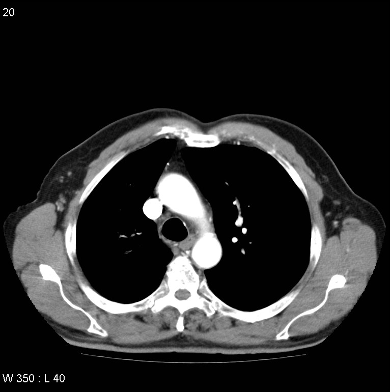Bronchial carcinoid tumor with right lower lobe collapse (Radiopaedia 29060-29422 A 19).jpg