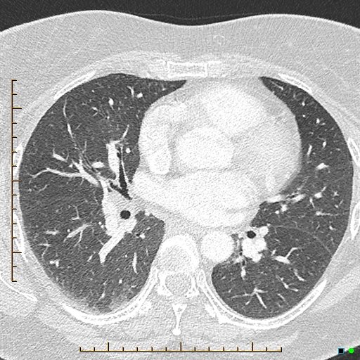 Bronchial diverticula (Radiopaedia 79512-92676 Axial lung window 104).jpg