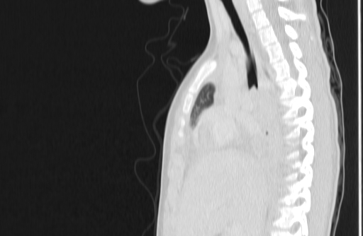 Bronchial mucoepidermoid carcinoma (Radiopaedia 57023-63895 Sagittal lung window 65).jpg