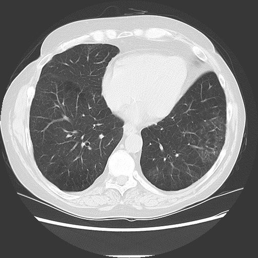 File:Bronchial stenosis - lung transplant (Radiopaedia 73133-83848 Axial lung window 44).jpg