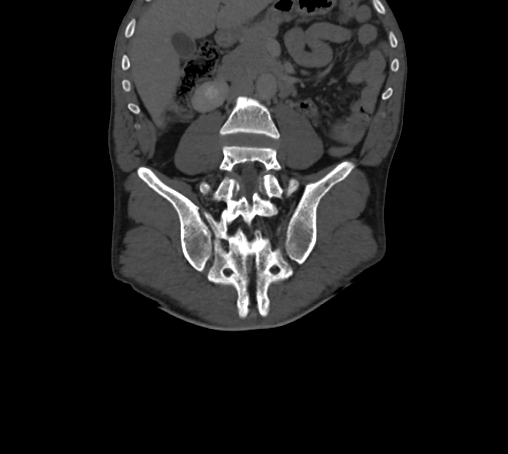 Bronchiectasis in Crohn disease (Radiopaedia 60311-67977 Coronal bone window 48).jpg