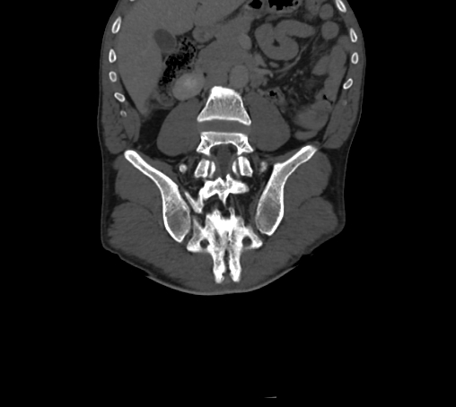 Bronchiectasis in Crohn disease (Radiopaedia 60311-67977 Coronal bone window 49).jpg