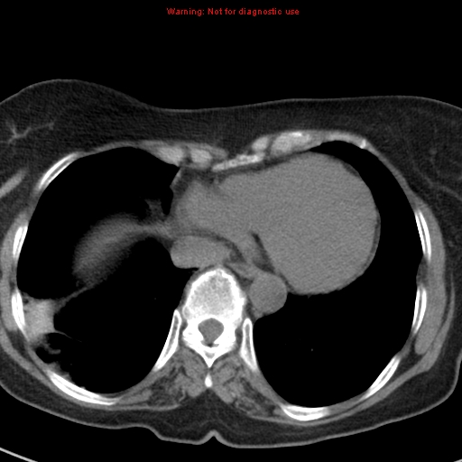 File:Bronchoalveolar carcinoma (BAC) (Radiopaedia 13436-13392 Axial non-contrast 38).jpg