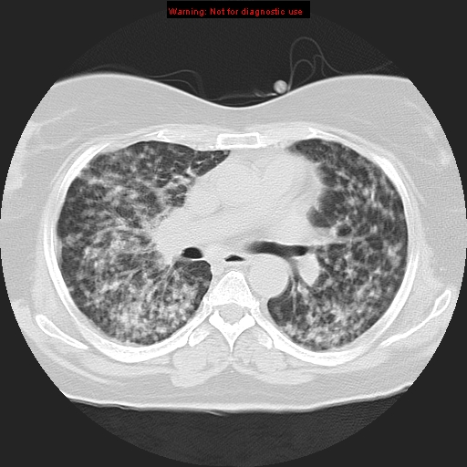 Bronchoalveolar carcinoma (Radiopaedia 13224-13233 Axial lung window 22).jpg