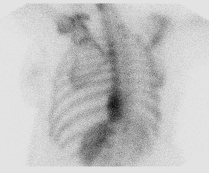 File:Bronchoalveolar carcinoma (Radiopaedia 13224-13234 A 9).jpg