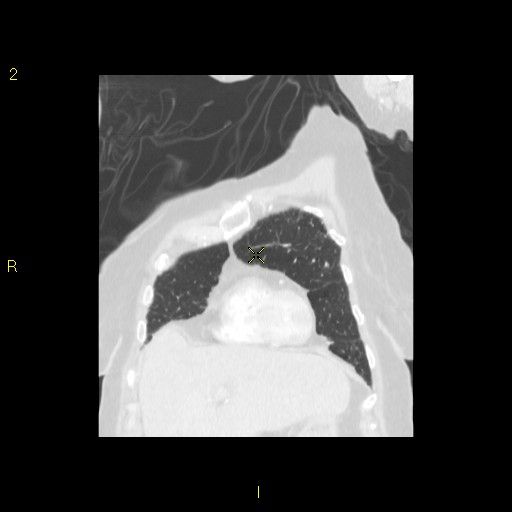 File:Bronchogenic carcinoma as an incidental finding (Radiopaedia 16453-16130 Coronal lung window 15).jpg